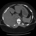 Adrenal myelolipoma (Radiopaedia 8216-9068 Axial non-contrast 4).jpg