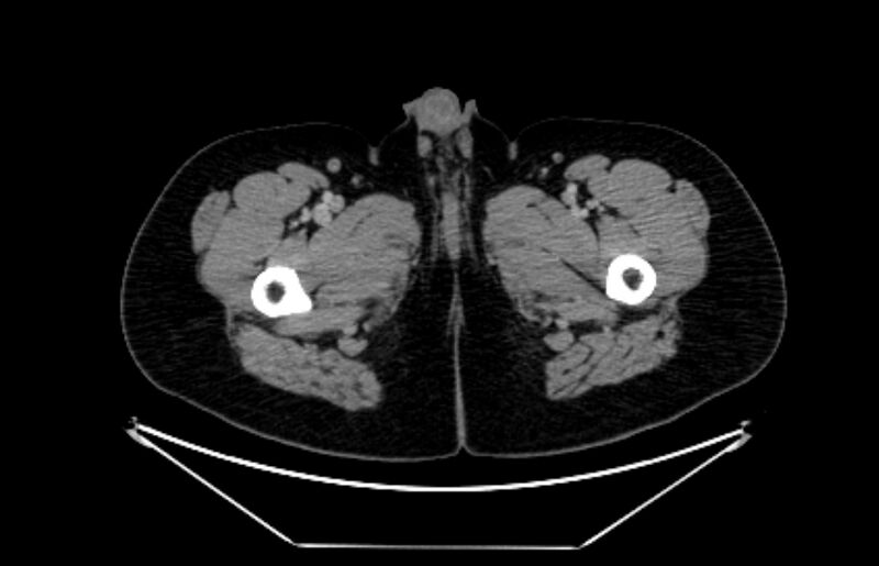 File:Adrenocortical carcinoma (Radiopaedia 80134-93438 Axial C+ portal venous phase 148).jpg