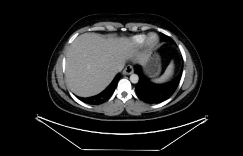 Adrenocortical carcinoma (Radiopaedia 80134-93438 Axial C+ portal venous phase 20).jpg
