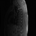 Aggressive vertebral hemangioma (Radiopaedia 39937-42404 B 15).png