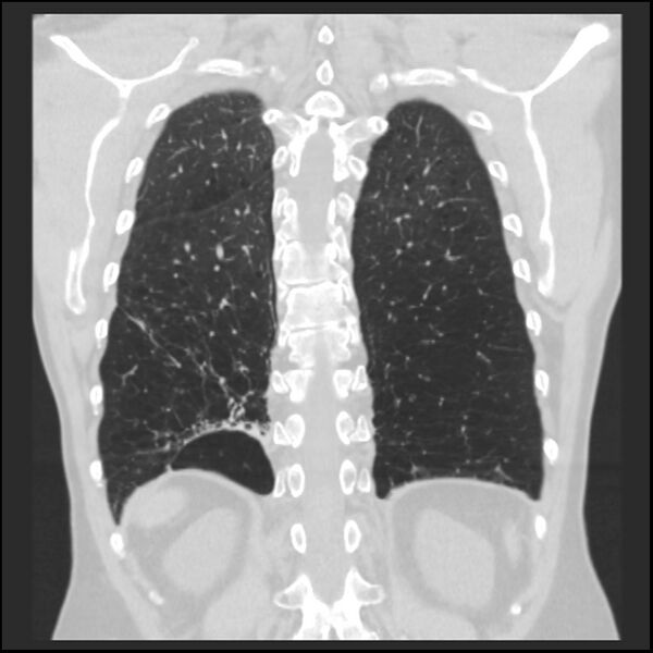 File:Alpha-1-antitrypsin deficiency (Radiopaedia 40993-43722 Coronal lung window 84).jpg