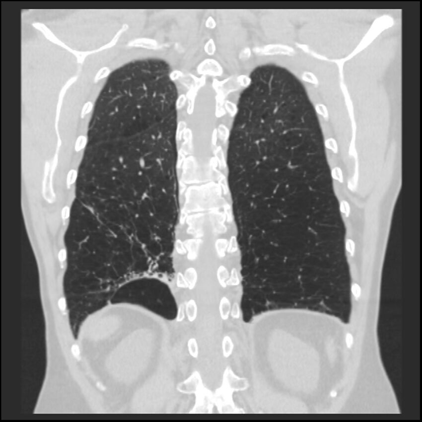 Alpha-1-antitrypsin deficiency (Radiopaedia 40993-43722 Coronal lung window 84).jpg