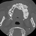 Ameloblastic fibro-odontoma (Radiopaedia 18843-18780 C 42).jpg