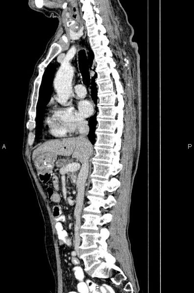 File:Ampullary adenocarcinoma (Radiopaedia 86093-102033 E 42).jpg