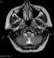 Amyotrophic lateral sclerosis (Radiopaedia 5373-7134 Axial T2 4).jpg