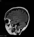 Amyotrophic lateral sclerosis (Radiopaedia 5373-7134 Sagittal FLAIR 23).jpg