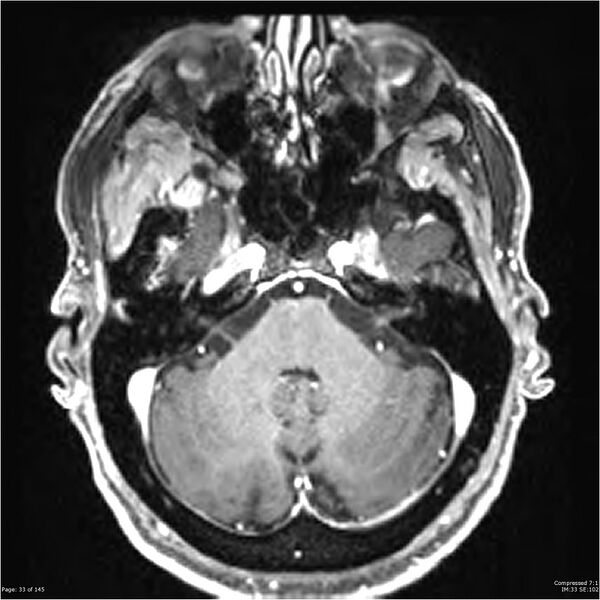 File:Anaplastic meningioma with recurrence (Radiopaedia 34452-35788 Axial T1 C+ 33).jpg