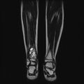 Aneurysmal bone cyst - tibia (Radiopaedia 22343-22367 Coronal T2 11).jpg