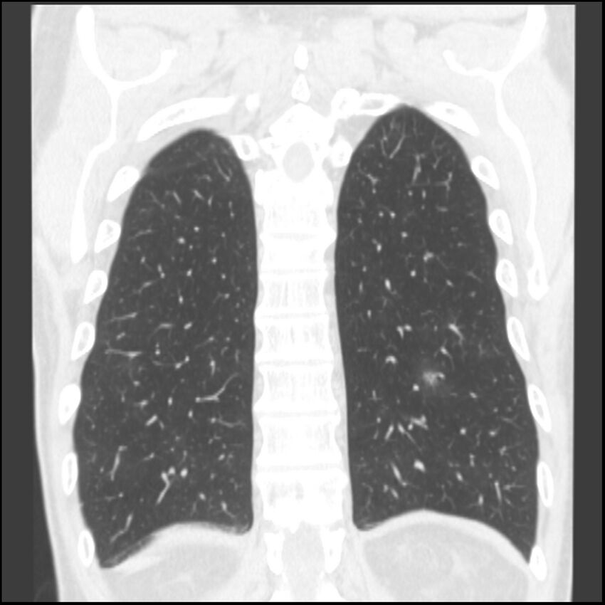 Angioinvasive aspergillosis (Radiopaedia 43957-47466 Coronal lung window 18).jpg