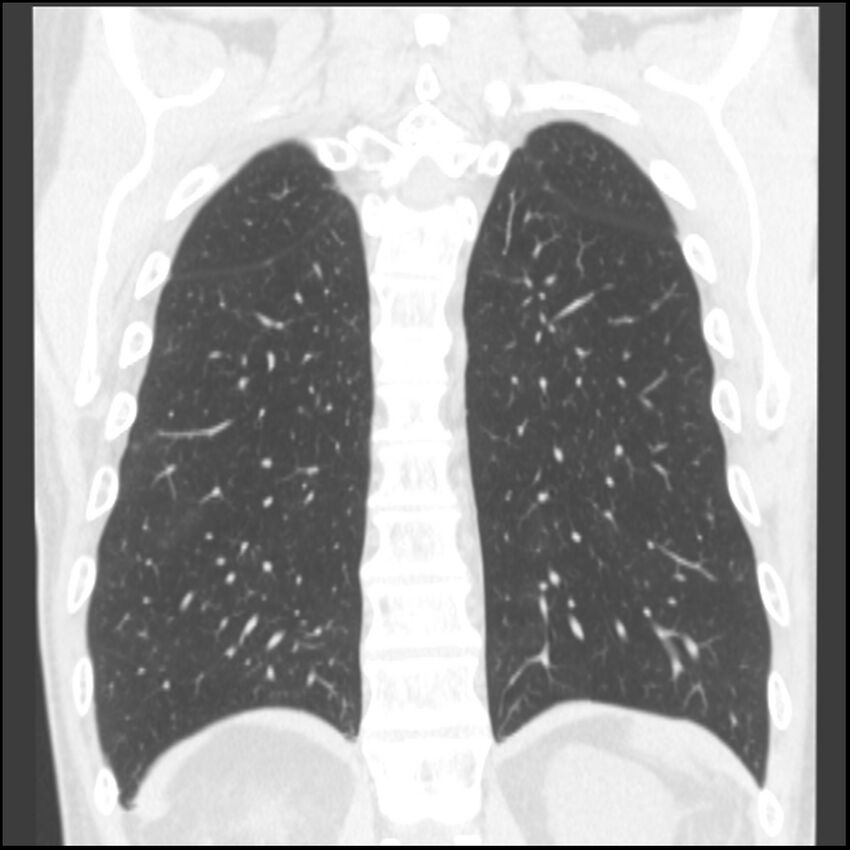 Angioinvasive aspergillosis (Radiopaedia 43957-47466 Coronal lung window 22).jpg