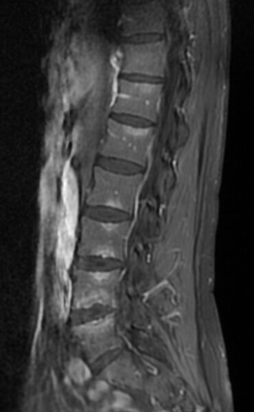 File:Ankylosing spondylitis - Andersson lesion (Radiopaedia 81878-95838 F 5).jpg