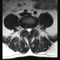 Ankylosing spondylitis with zygapophyseal arthritis (Radiopaedia 38433-40516 Axial T2 6).jpg