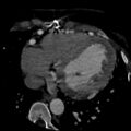 Anomalous left coronary artery from the pulmonary artery (ALCAPA) (Radiopaedia 40884-43586 A 59).jpg