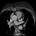 Anomalous origin of left circumflex artery from right coronary sinus (Radiopaedia 72563-83117 B 28).jpg