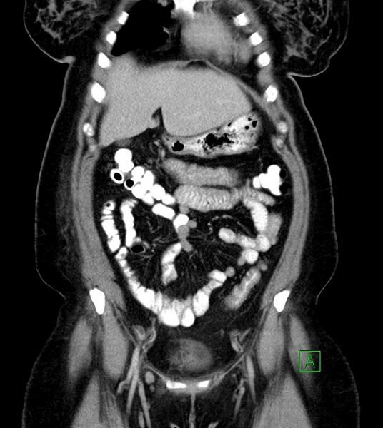 File:Anterior abdominal wall CSF pseudocyst (CSFoma) (Radiopaedia 79453-92571 B 19).jpg