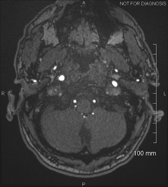 File:Anterior cerebral artery aneurysm (Radiopaedia 80683-94127 Axial MRA 17).jpg