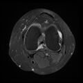 Anterior cruciate ligament tear, Wrisberg rip and bucket-handle tear of medial meniscus (Radiopaedia 75872-87266 Axial PD fat sat 13).jpg