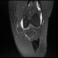 Anterior cruciate ligament tear, Wrisberg rip and bucket-handle tear of medial meniscus (Radiopaedia 75872-87266 Coronal PD fat sat 8).jpg