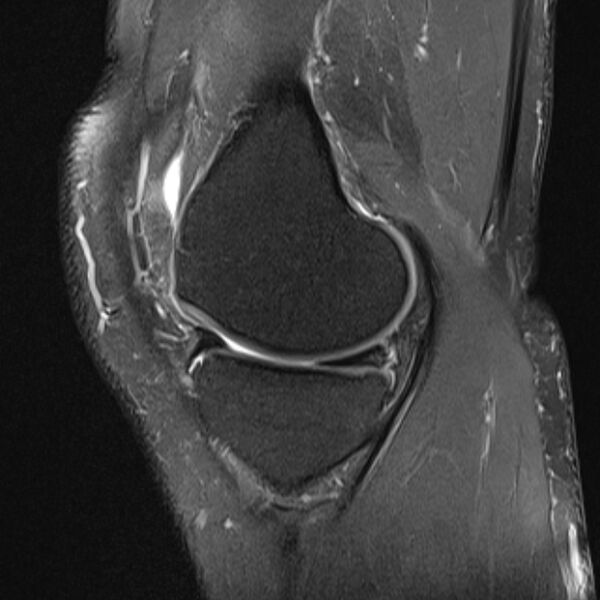 File:Anterior cruciate ligament tear - ramp lesion (Radiopaedia 71883-82322 Sagittal PD fat sat 18).jpg