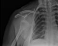 Anterior dislocation of shoulder (Radiopaedia 13397-13380 Frontal 1).jpg