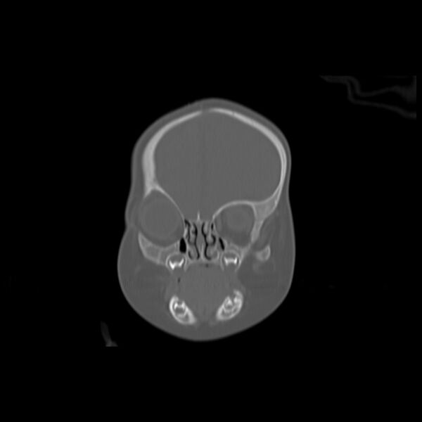 File:Anterior plagiocephaly (Radiopaedia 71836-82273 Coronal bone window 13).jpg