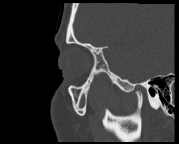 File:Antrochoanal polyp (Radiopaedia 21894-21868 Sagittal bone window 1).jpg