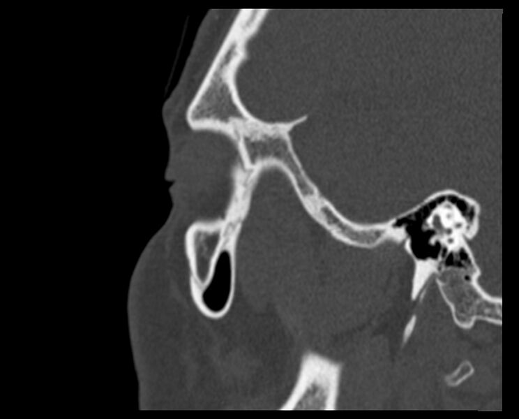 File:Antrochoanal polyp (Radiopaedia 21894-21868 Sagittal bone window 39).jpg