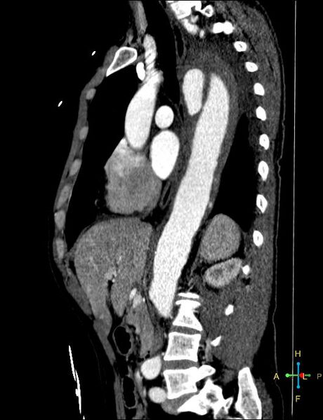 File:Aortic aneurysm and penetrating ulcer (Radiopaedia 23590-23704 C 22).jpg