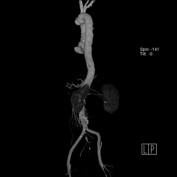 File:Aortic arch saccular aneurysm (Radiopaedia 19430-19457 A 8).jpg
