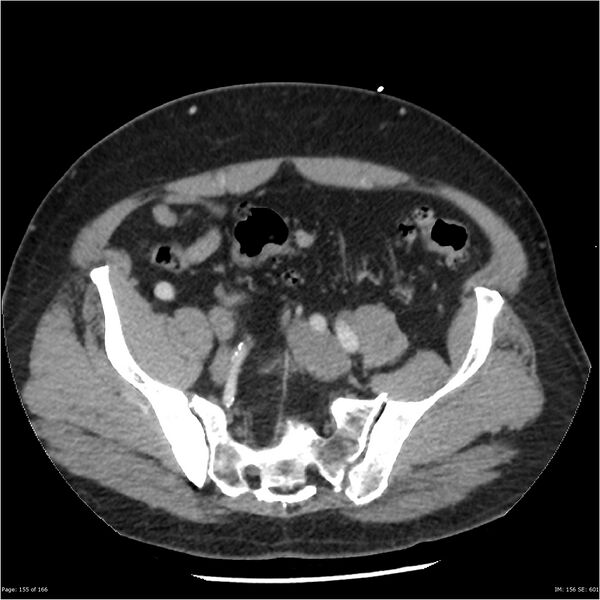 File:Aortic dissection- Stanford A (Radiopaedia 37759-39664 A 146).jpg