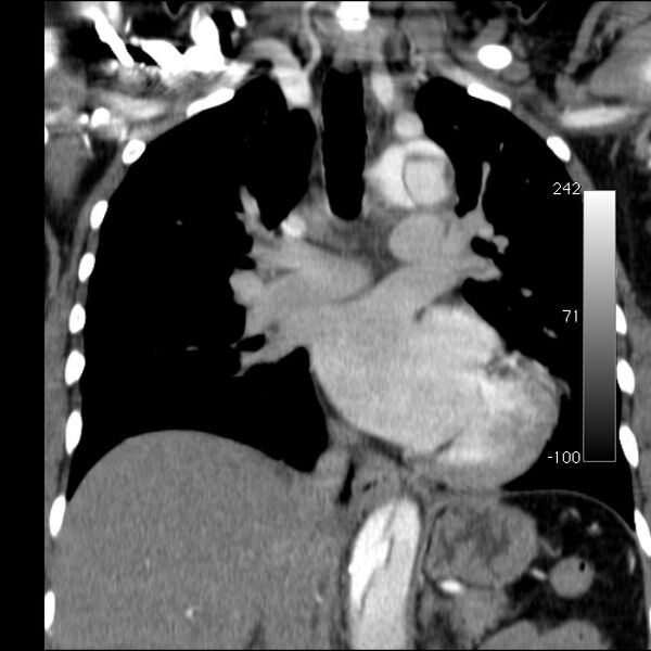 File:Aortic dissection - Stanford type A (Radiopaedia 29247-29659 B 33).jpg