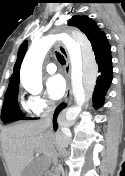 File:Aortic dissection - Stanford type B (Radiopaedia 50171-55512 C 31).png