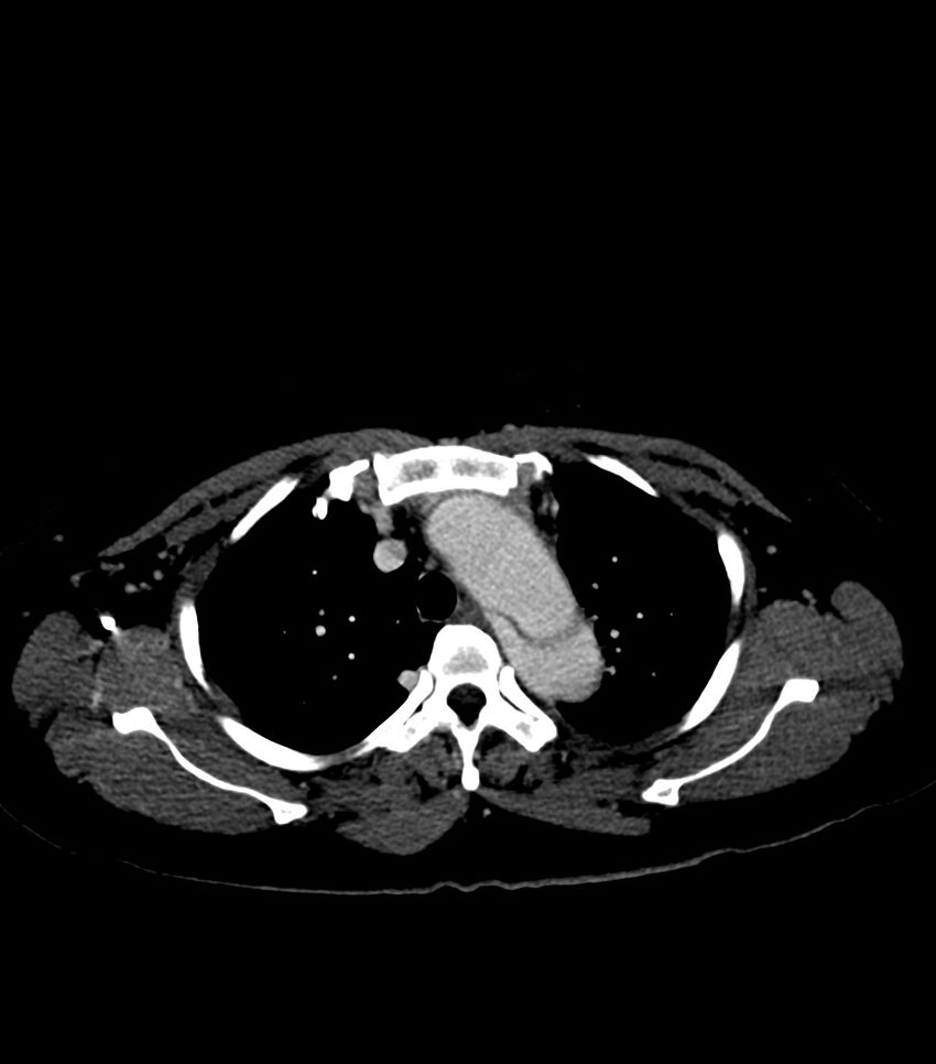 Aortic dissection with renal ischemia (Radiopaedia 76573-88338 B 9).jpg