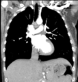 Aortic valve non-coronary cusp thrombus (Radiopaedia 55661-62189 C 38).png