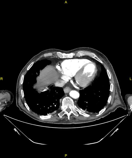 File:Aortoenteric fistula (Radiopaedia 84308-99603 B 7).jpg