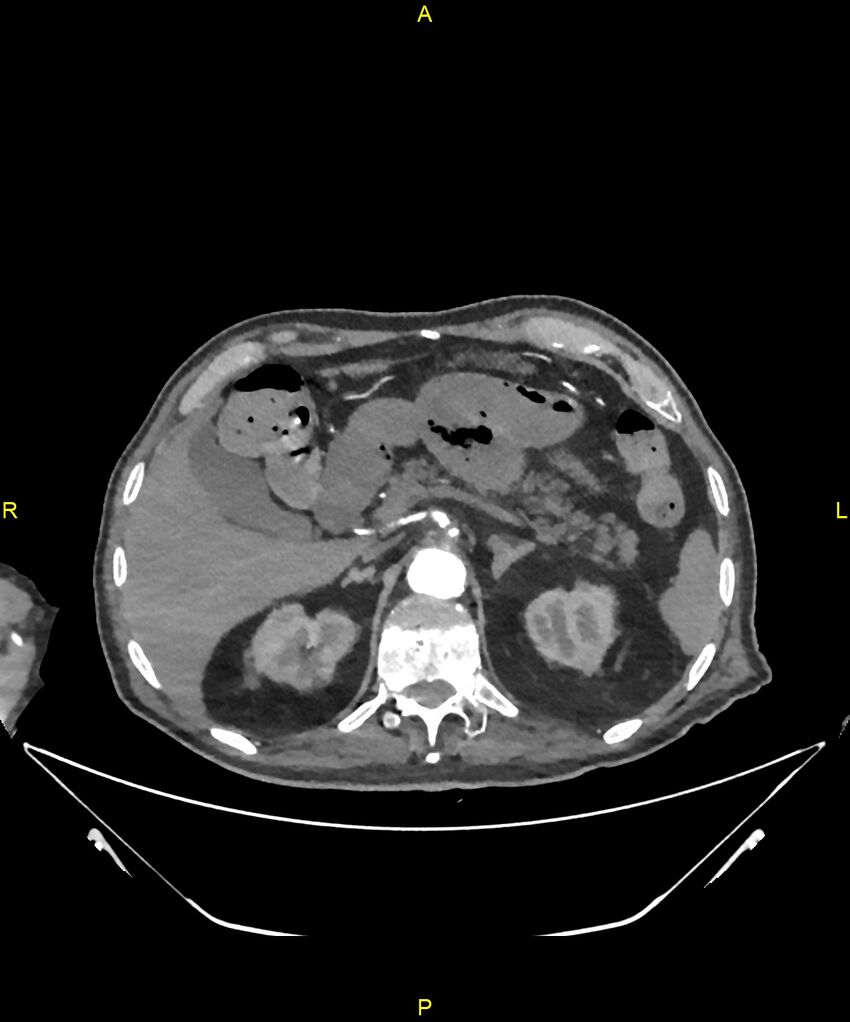 Aortoenteric fistula (Radiopaedia 84308-99603 B 81).jpg