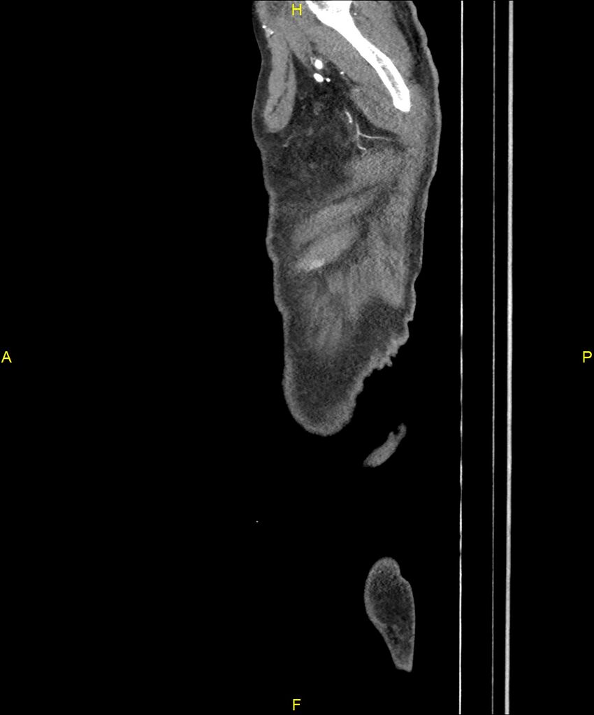 Aortoenteric fistula (Radiopaedia 84308-99603 C 336).jpg
