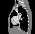 Aortopulmonary window, interrupted aortic arch and large PDA giving the descending aorta (Radiopaedia 35573-37074 C 2).jpg
