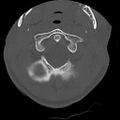 Apical pneumothorax on cervical spine CT (Radiopaedia 45343-49368 Axial bone window 11).jpg