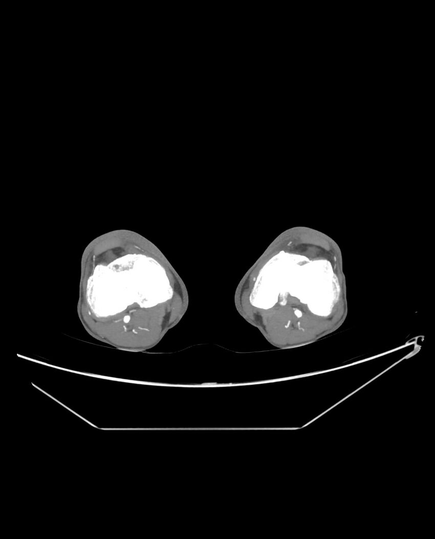 Aplastic posterior tibial arteries (Radiopaedia 84021-99249 A 186).jpg
