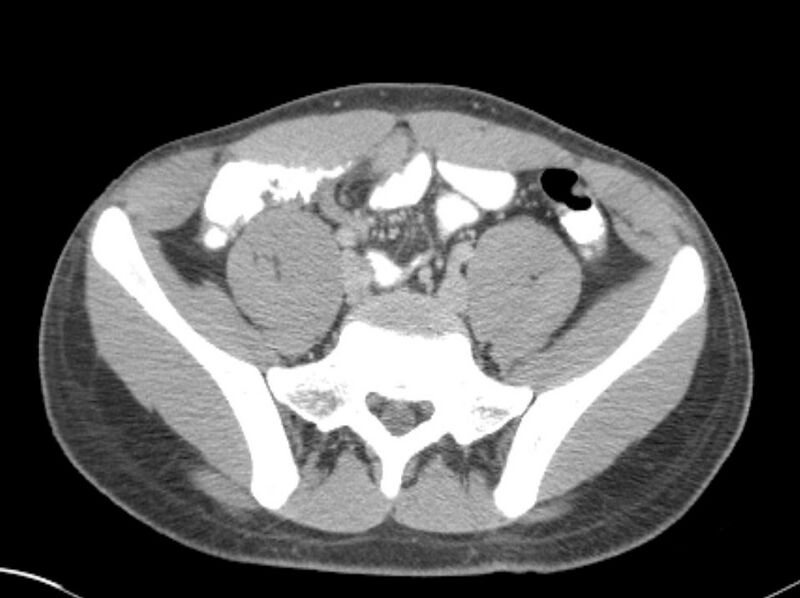 File:Appendicitis and incidental foregut duplication cyst (Radiopaedia 52962-58916 A 65).jpg
