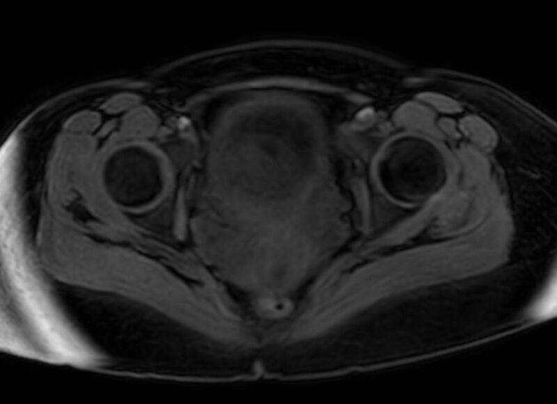File:Appendicitis in gravida (MRI) (Radiopaedia 89433-106395 Axial DIXON 139).jpg