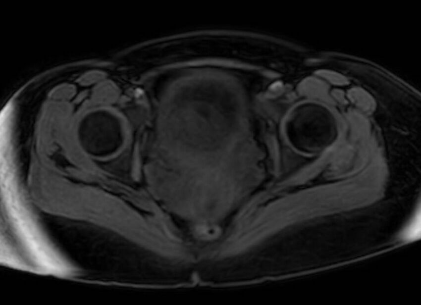 Appendicitis in gravida (MRI) (Radiopaedia 89433-106395 Axial DIXON 139).jpg