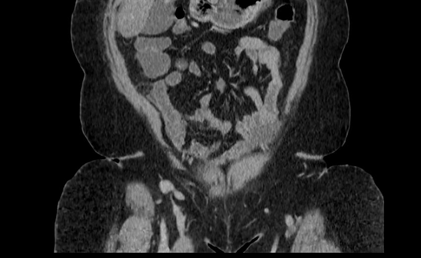 Appendix mucocele (Radiopaedia 41222-44033 B 9).jpg