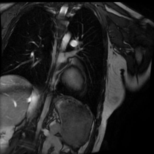 File:Arrhythmogenic right ventricular cardiomyopathy (Radiopaedia 87505-103850 2ch (LV) Cine SSFP 70).jpg