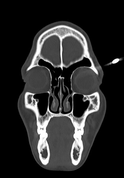 File:Arrow injury to the head (Radiopaedia 75266-86388 Coronal bone window 24).jpg