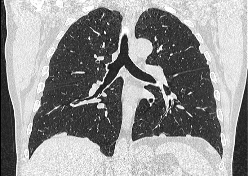 File:Asbestos pleural placques (Radiopaedia 57905-64872 Coronal lung window 166).jpg