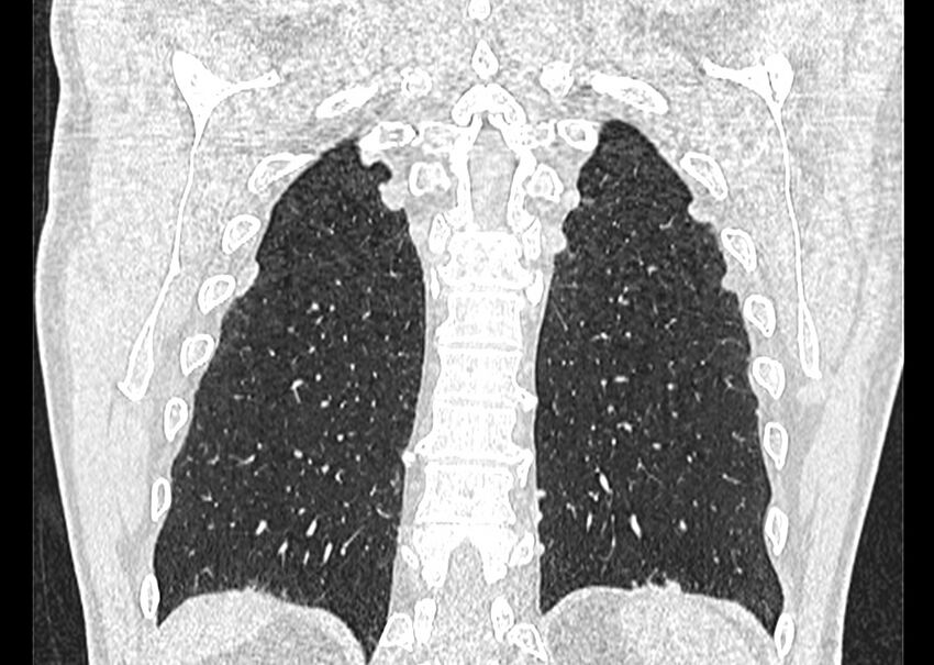 Asbestos pleural placques (Radiopaedia 57905-64872 Coronal lung window 239).jpg