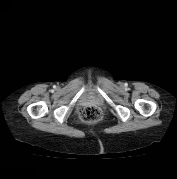 File:Autosomal dominant polycystic kidney disease (Radiopaedia 16777-16490 A 59).jpg