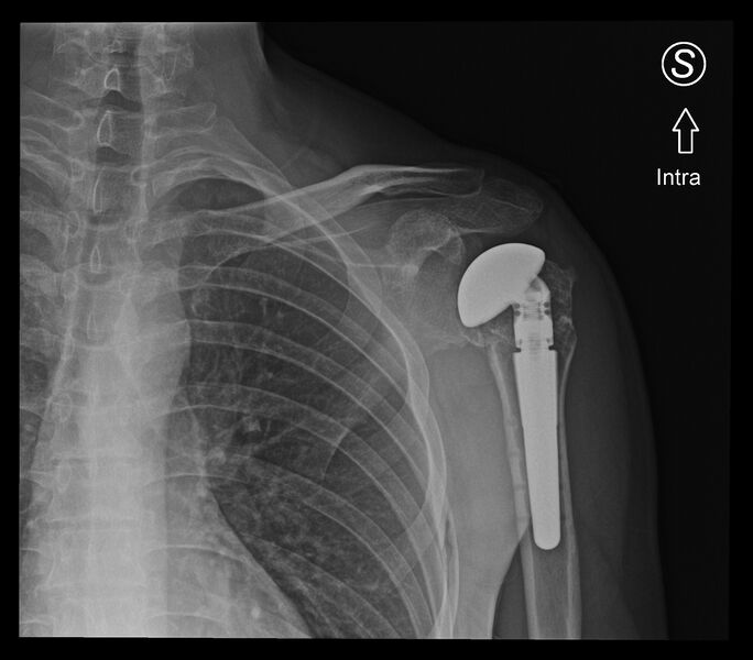 File:Avascular necrosis after fracture dislocations of the proximal humerus (Radiopaedia 88078-104656 Frontal 1).jpg